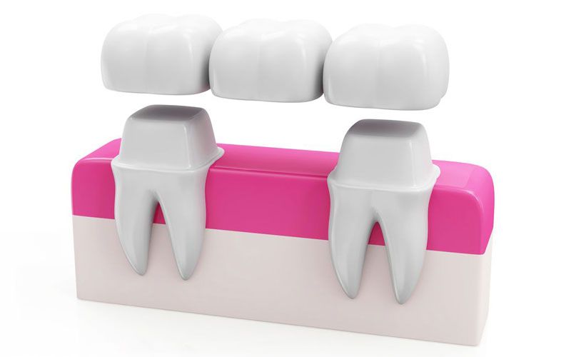 illustration of dental bridge