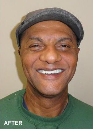 image of after dental implants and restorations
