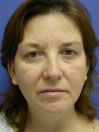 Devlin Cosmetic Surgery patient before and after chemical peel