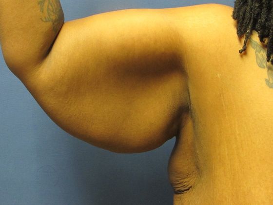 Flexing upper arm with loose skin