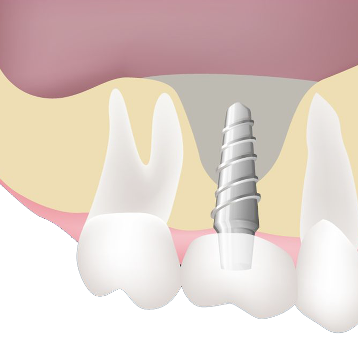 illustration of sinus lift