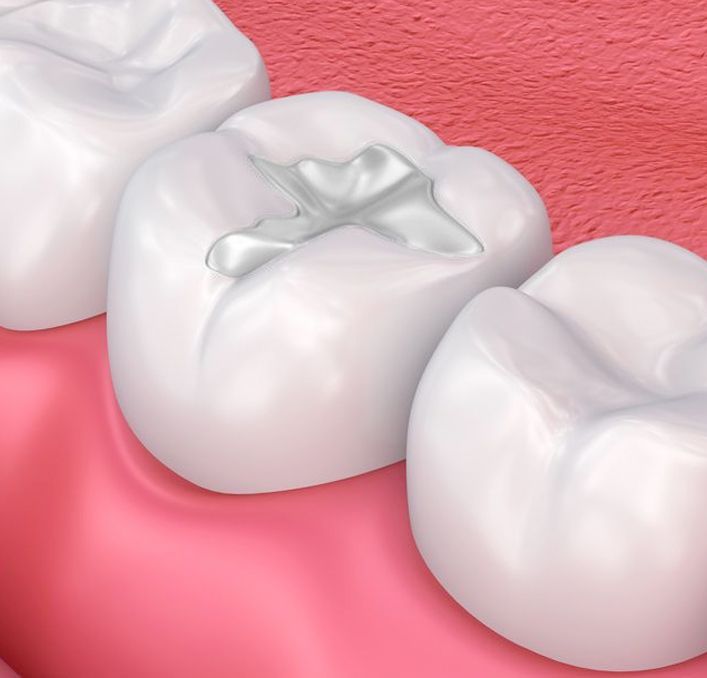 dental filling illustration