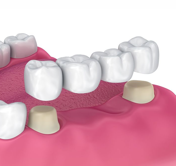 dental bridge illustration