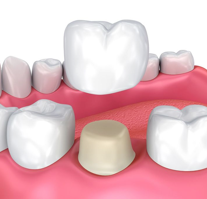 dental crown illustration