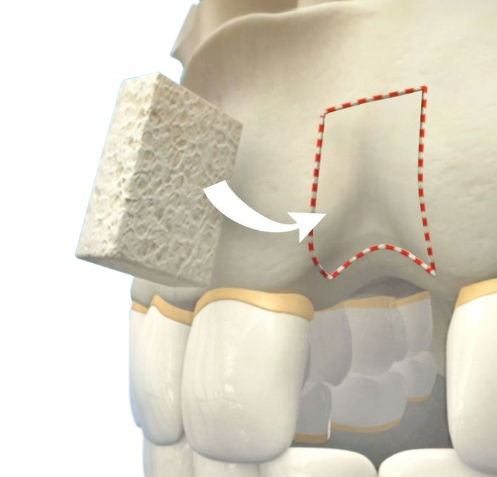 bone graft illustration