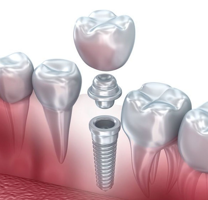dental implants illustration
