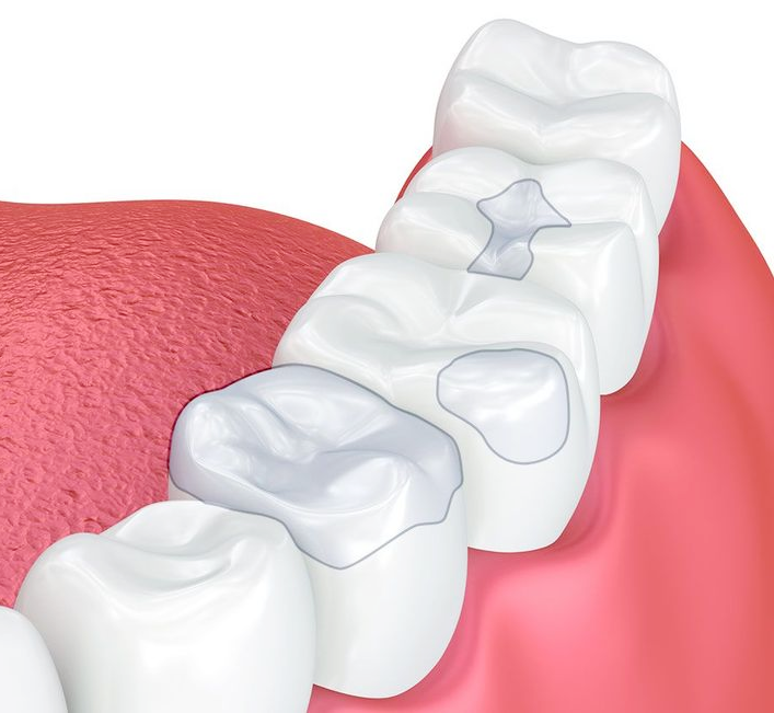 illustration of inlays and onlays