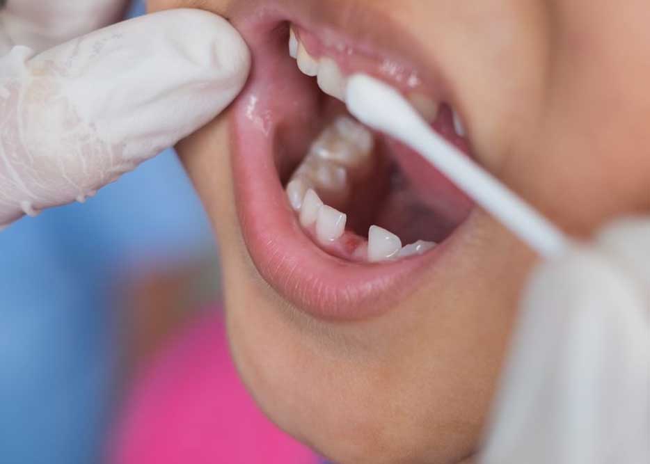 A close up of a dentist applying fluoride to a child's tooth