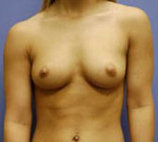 before breast augmentation photo