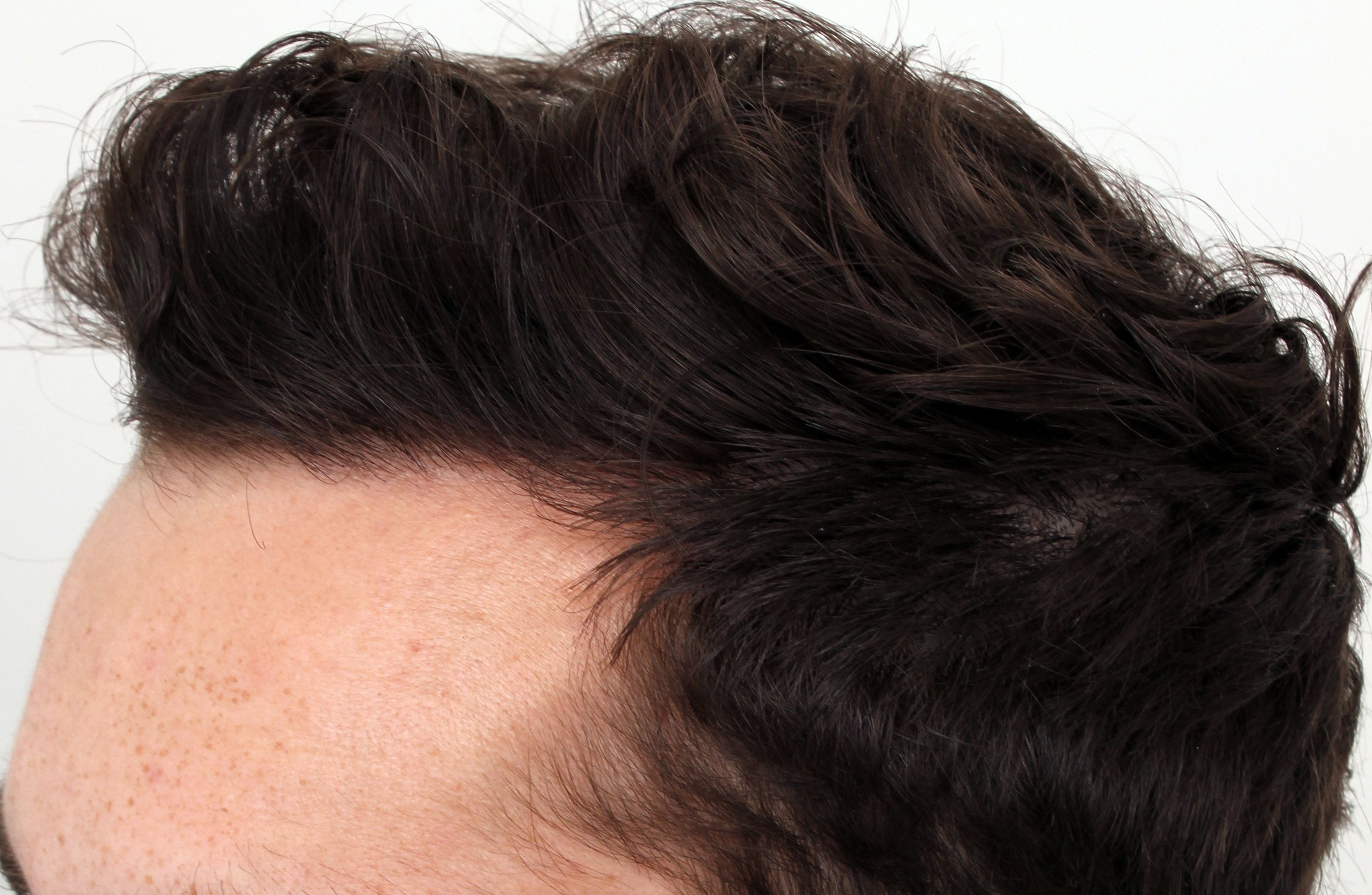 Doctor examining male patient's hairline