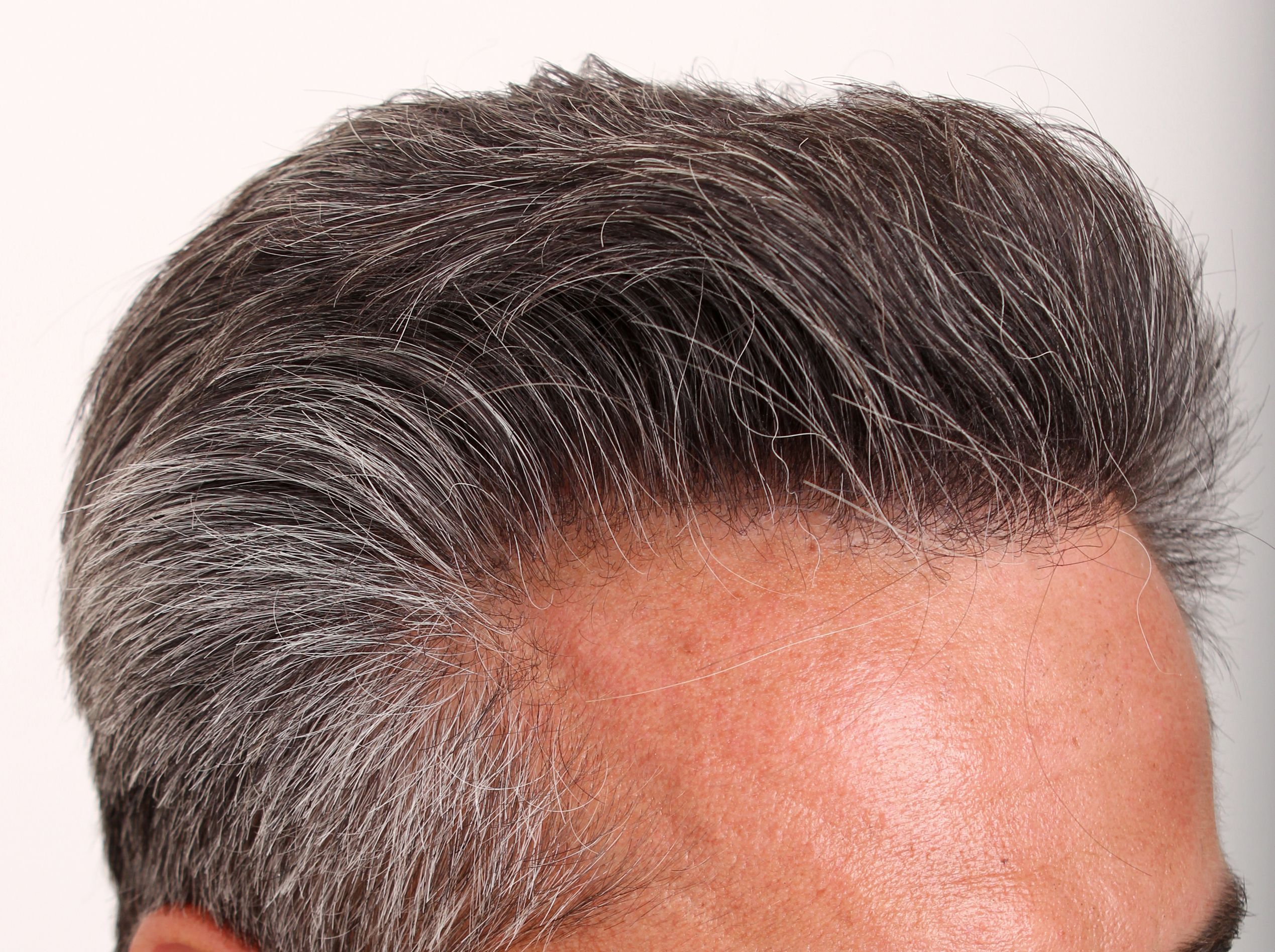 Concerned-looking man examining his hairline