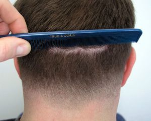 after hair restoration