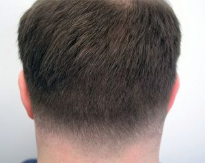 after hair restoration