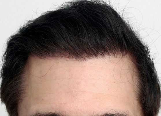 Hair restoration patient
