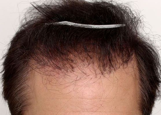 Hair restoration patient