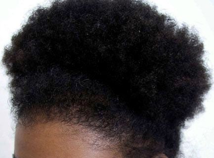 After hair restoration