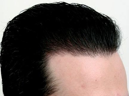 After hair restoration