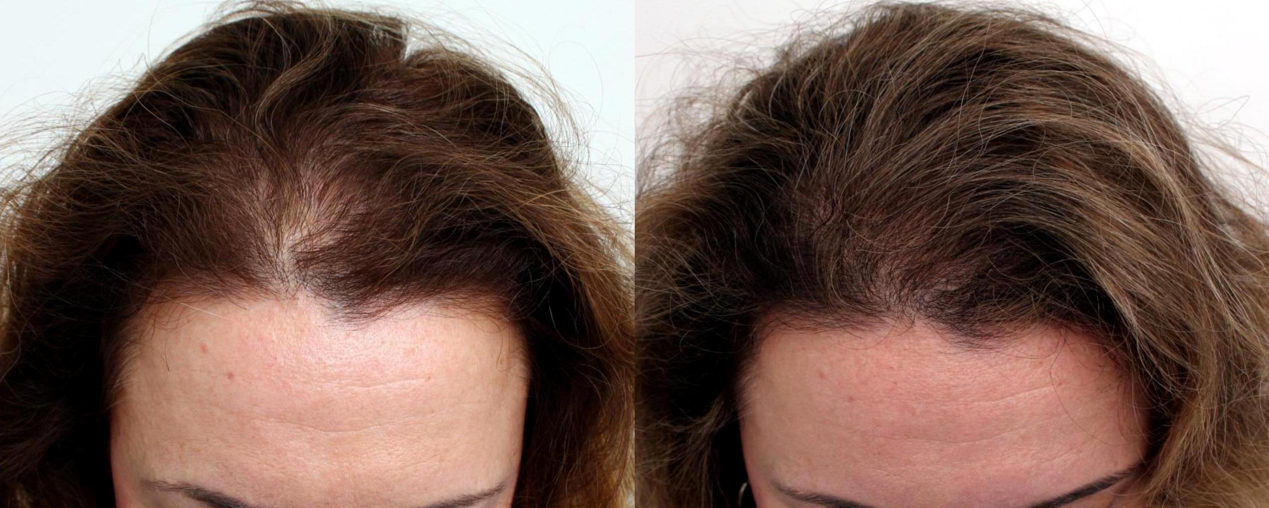 Hair Loss In Women NYC NY True Dorin Medical Group Hair Loss In Women NYC NY True Dorin Medical Group