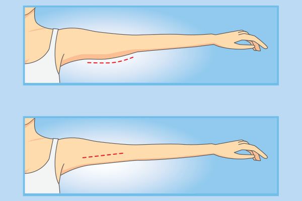 Posterior and anterior arm lift techniques