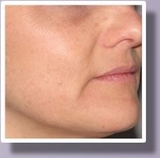 An after view of a woman's face after IPL photofacial treatment.