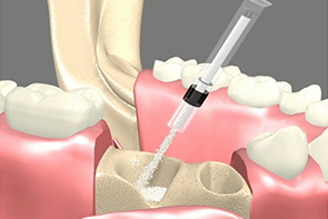 bone grafting