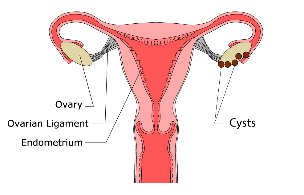 illustration of PCOS