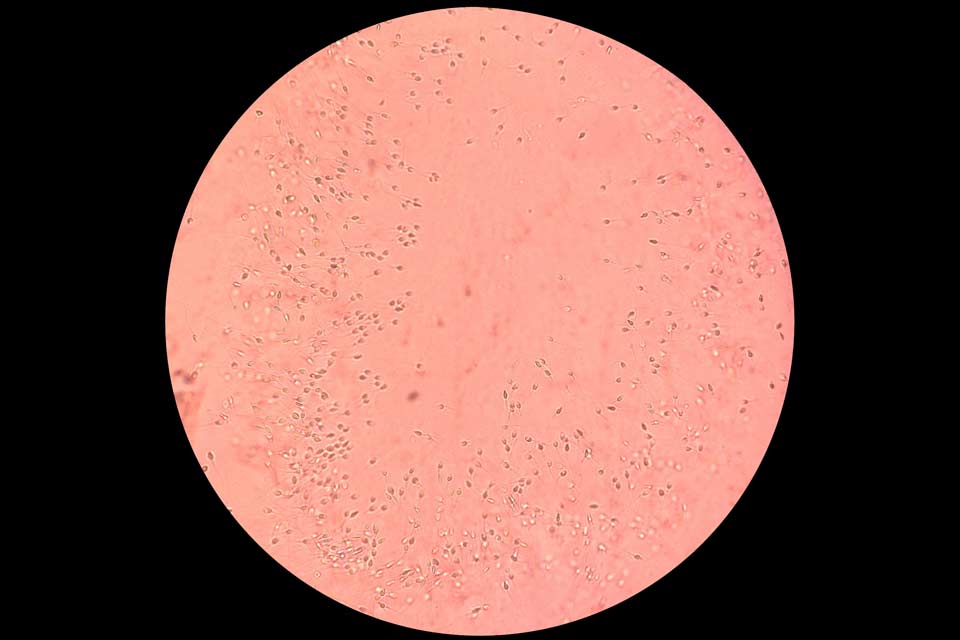 image of male factor infertility