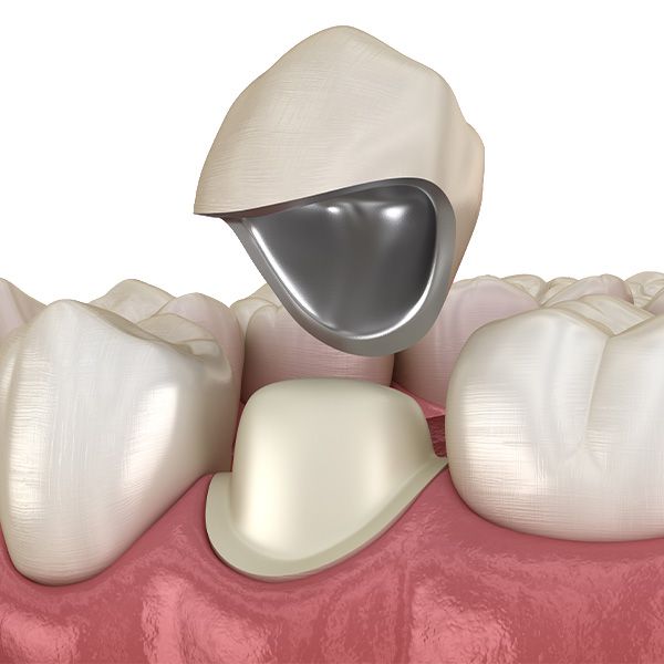 Porcelain-Fused-to-Metal crown