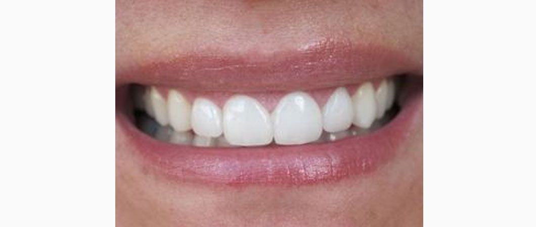 After treatment