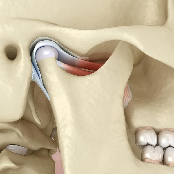 3-d representation of inflamed jaw joint