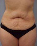before tummy tuck