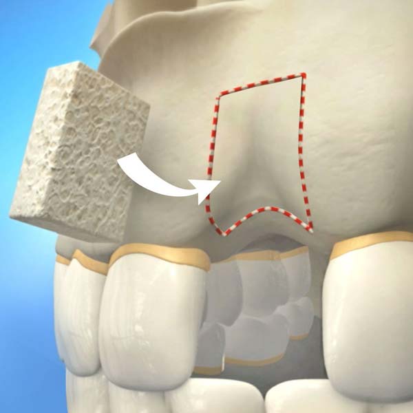 An illustration of dental bone grafting