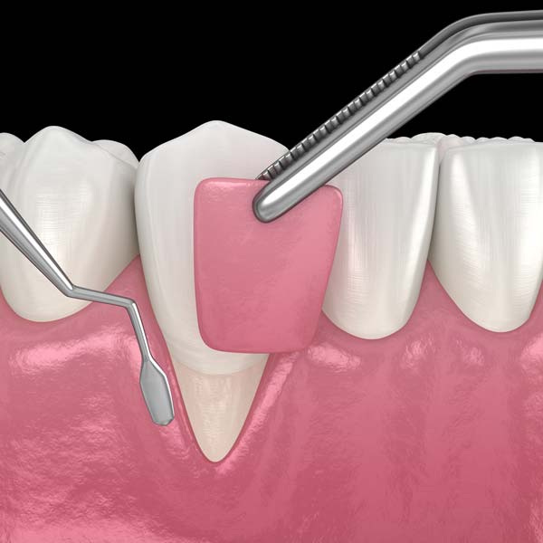 An illustration of a soft tissue graft