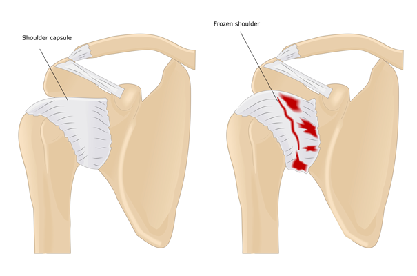 correct pillow for frozen shoulders