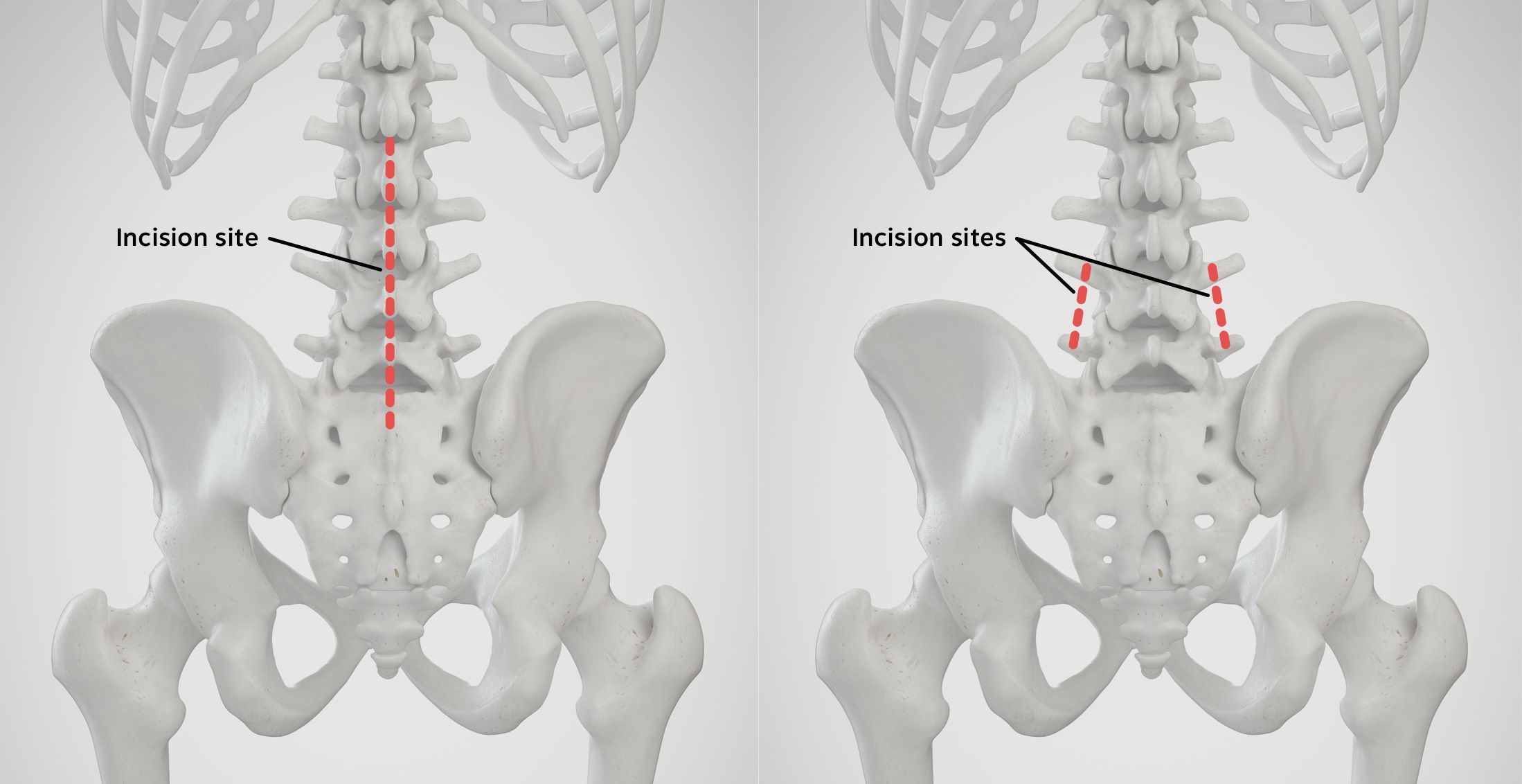Spine Surgery Austin, TX Orthopaedic Specialists of Austin
