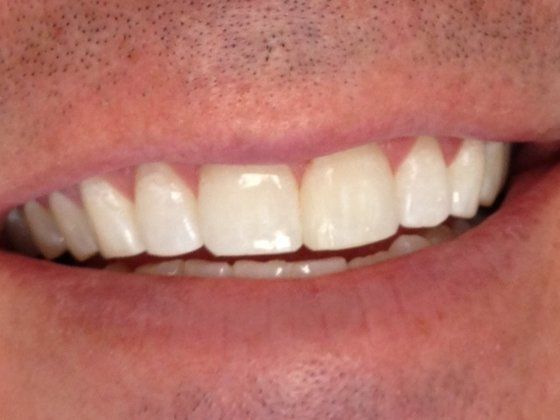After: patient's smile without gap.