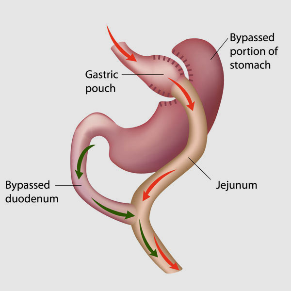 Gastric Bypass