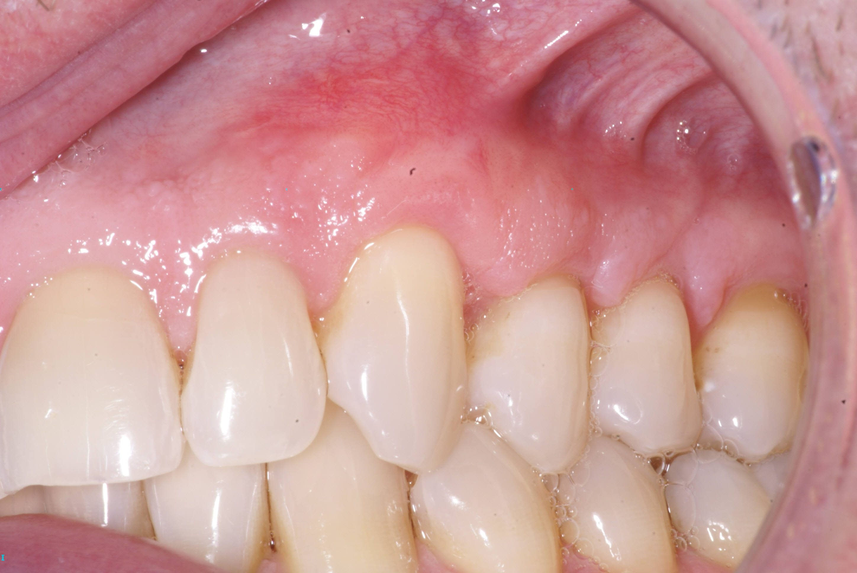 Periodontist Ocean, NJ Monmouth County, NJ Dr. Andrew Samuel