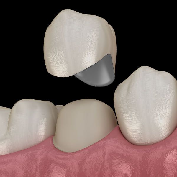 Illustration of dental crown