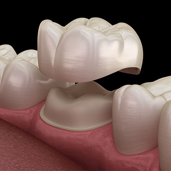 Illustration of dental crown