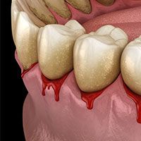 Periodontal Disease