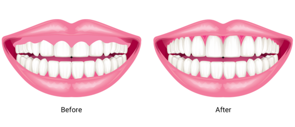 A before and after illustration of gum contouring