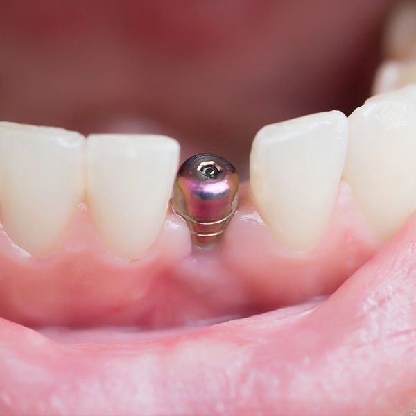 dental implant