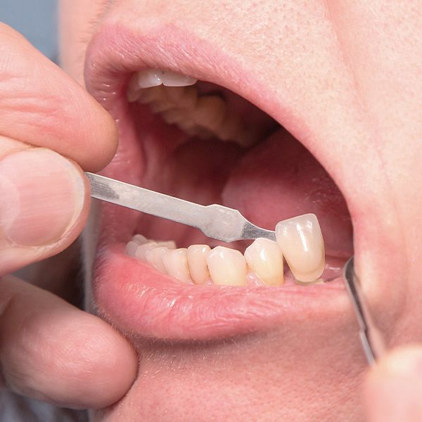 A dental crown being placed in a mouth