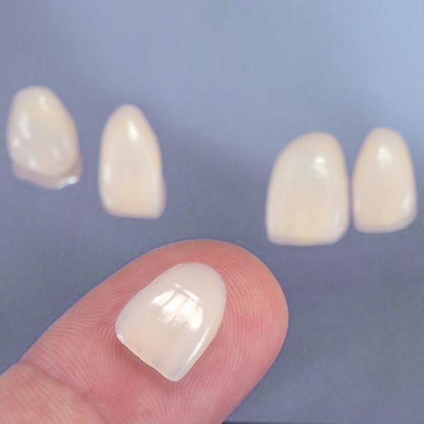 A porcelain veneer on a fingertip