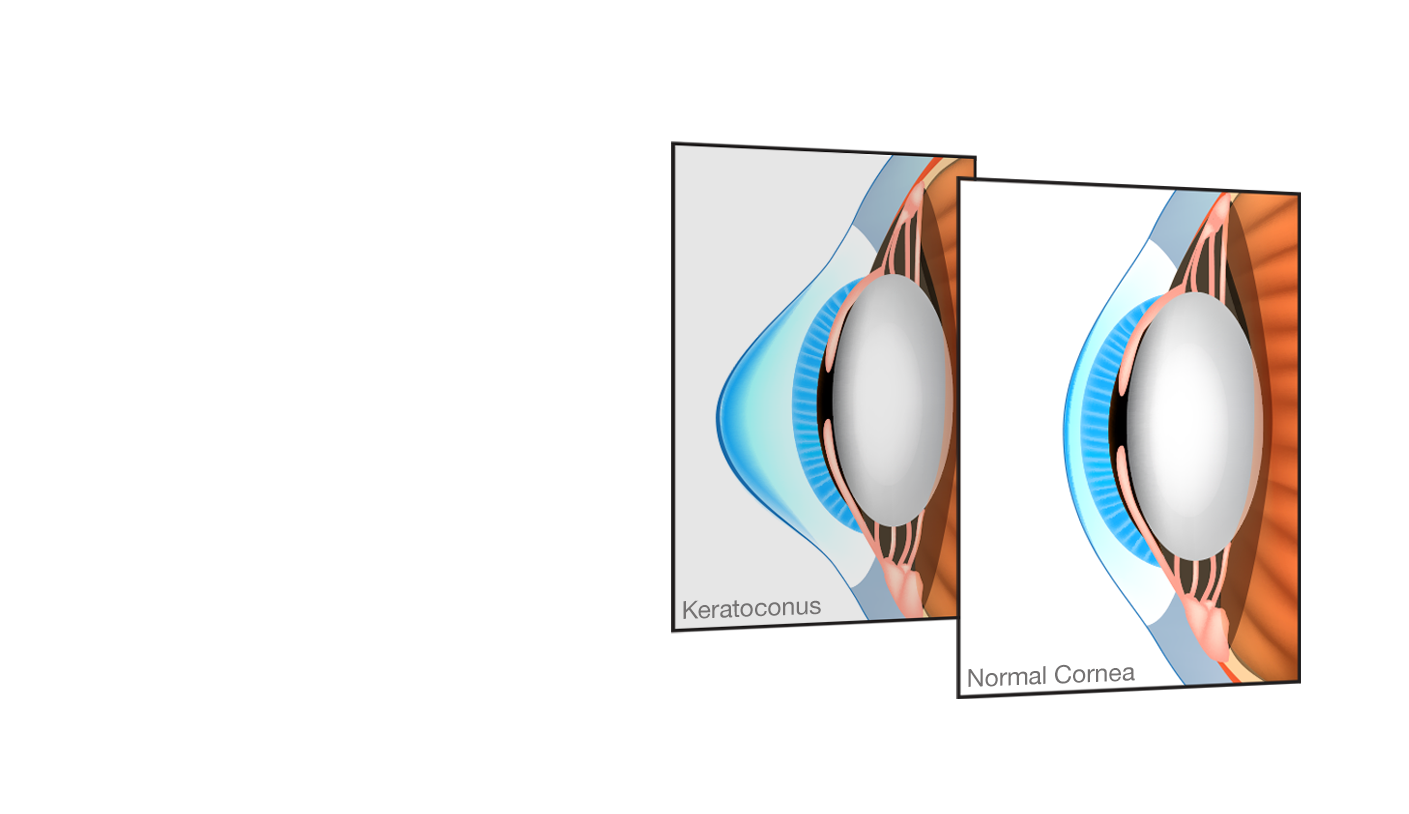 Keratoconus New Jersey West Orange Nj Northern New Jersey