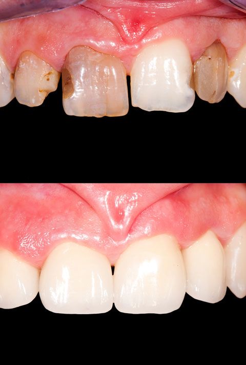 Dental crowns