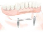Illustration of implant-supported denture