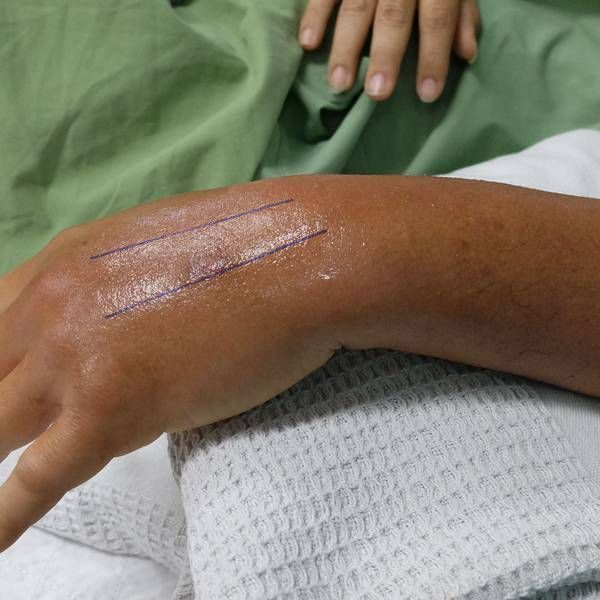 Closeup of patient's wrist elevated on pillow