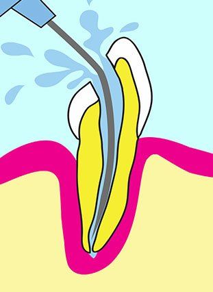 Brightly colored cutaway graphic of a tooth being cleaned out